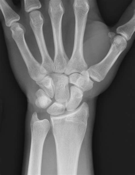Search Results Normal Wrist Xray Besttemplatess