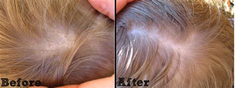 One way to treat cradle cap is to warm a small amount of clean, natural oil such as jojoba, almond, coconut or q: Get Rid of Cradle Cap Naturally • New Life On A Homestead ...