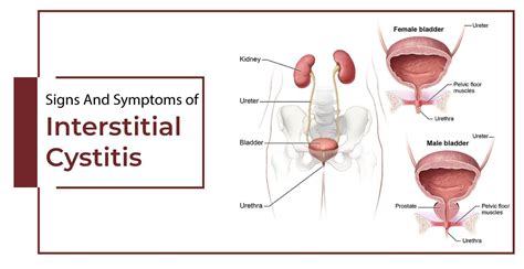 Interstitial Cystitis Sign Symptoms Causes Treatments