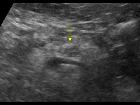 Transverse Focal Fatty Changes In The Pancreas Mimicking A Hypoechoic