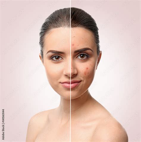 Woman Face Before And After Acne Treatment Procedure Skin Care Concept Stock Photo Adobe Stock
