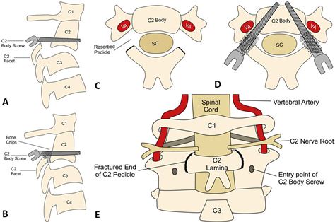 Management Of Neglected Complex Hangmans Fracture By Reforming The C2