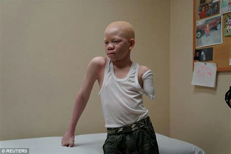 Tanzania Albino Kids Attacked For Rituals Get Free Care In The Us