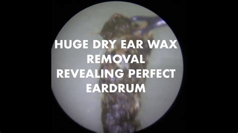 Huge Dry Ear Wax Removal Revealing Perfect Eardrum Ep 16 Youtube