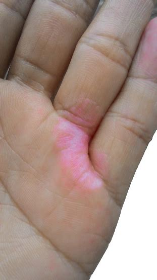 Male Hand With Eczema Stock Photo Download Image Now Palm Of Hand