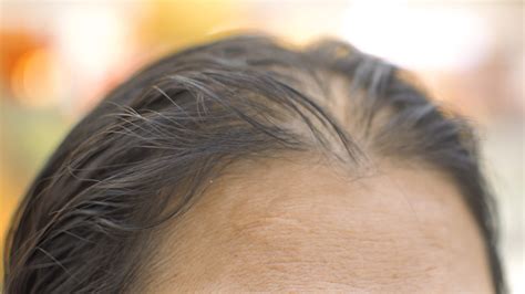 Hair Loss Treatment For Menopause Thinning Svenson