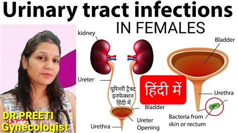 Peshab Mein Jalan Urine Infection Symptomsuti Symptom In Women Urine Infection In Females