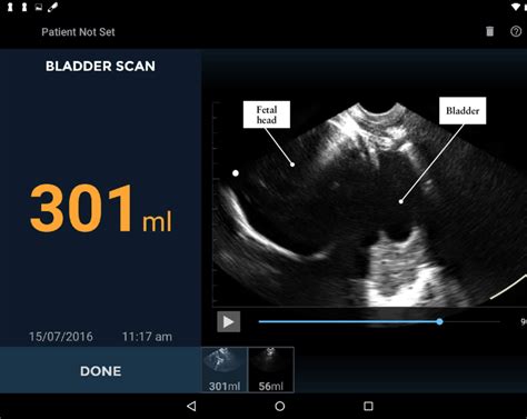 Antenatal Scan Showing Fetal Head And An Elongated Bladder Download