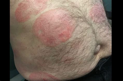 Large Scaly Erythematous Patches Clinical Advisor