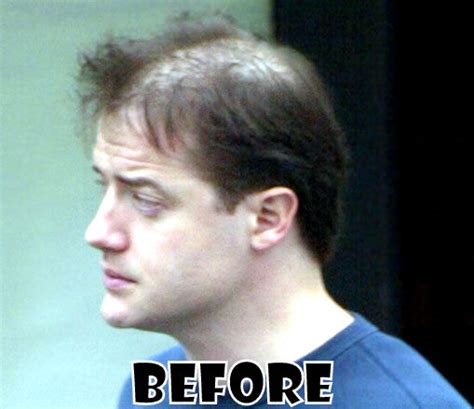 Brendan Fraser Plastic Surgery Before And After Hair Transplant Photos