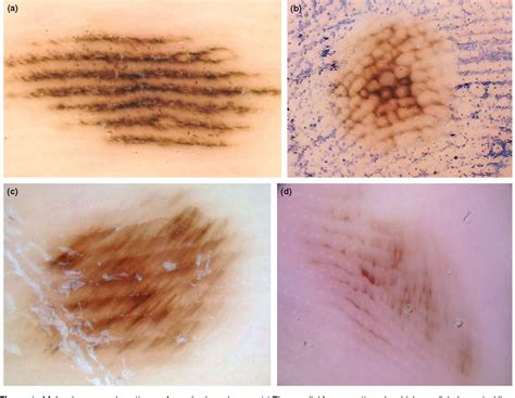 Dermoscopy Benign Melanocytic Lesions Dermnet