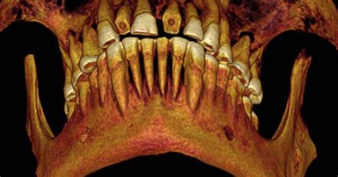 Mummy Discovered With Mouthful Of Cavities Cbs News