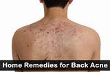 Photos of In Home Remedies For Acne
