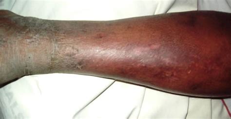 Cellulitis Risk Factors Causes And Treatment Medical Blog For Students