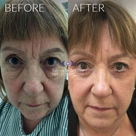 Natural Looking Eye Bag Surgery By Leading Cosmetic Eye Surgeon