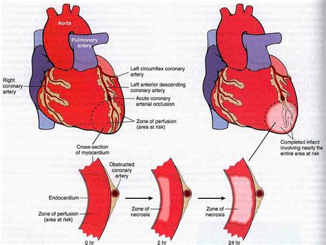 What Is Myocardial Infarction