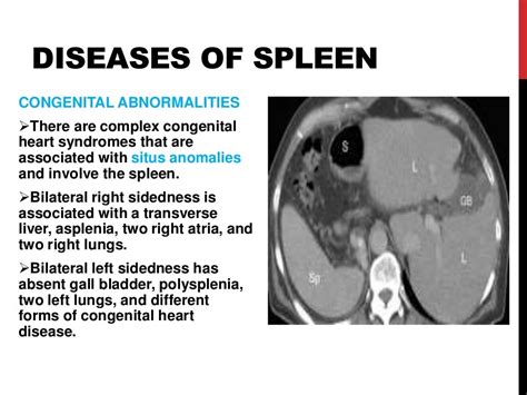 Spleen Diseases Pictures