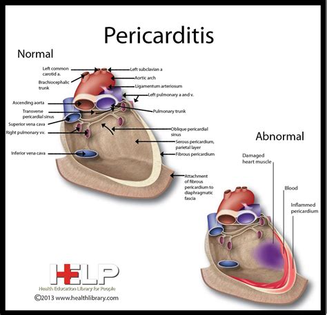 Pericarditis Nursing Pinterest