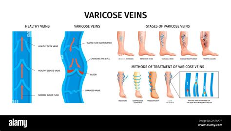 Varicose Veins Realistic Infographics Vector Illustration With Stages
