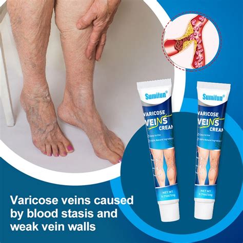 20g Varicose Veins Treatment Cream Varicosity Angiitis Remedy Ointment