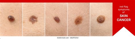 Understanding The Different Types Of Moles Spot Check Clinic Vlr Eng Br