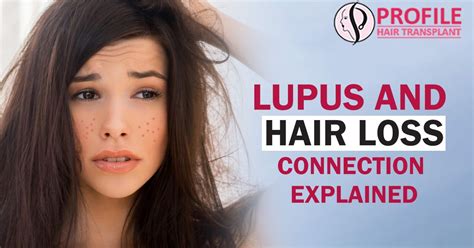 The good news is that there are ways to treat this hair fall. Lupus And Hair Loss - Connection Explained #hairtransplant ...