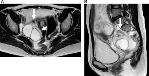 mri scan showing torsion of the right ovary with a corpus luteum cyst download scientific
