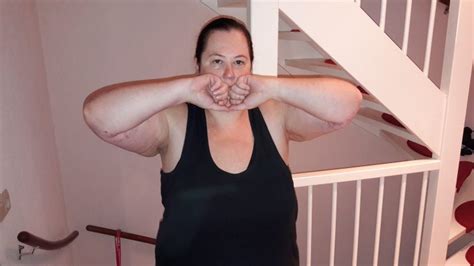 Arm Liposuction Follow Up What Is Lipedema