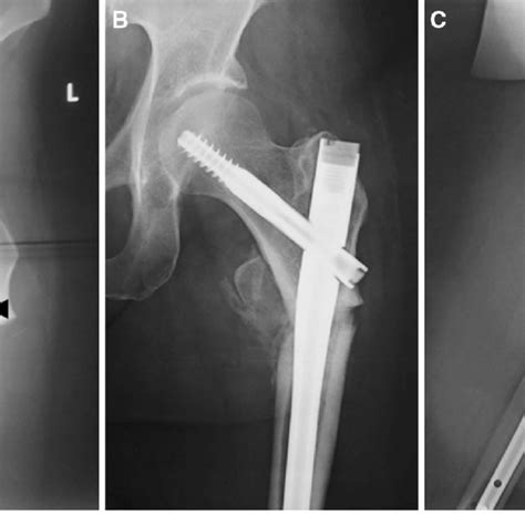 Anteroposterior Radiograph Of The Left Hip Shows A Subtrochanteric