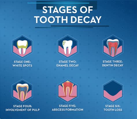 Stages Of Cavities