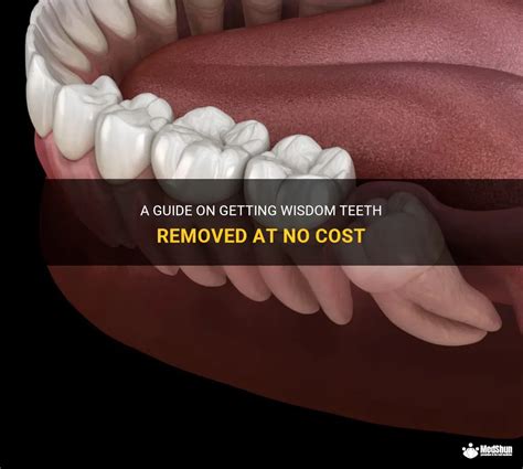 A Guide On Getting Wisdom Teeth Removed At No Cost Medshun