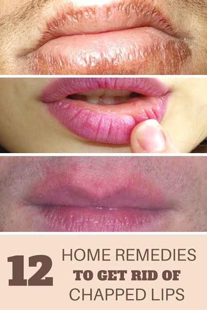 How To Get Rid Of Chapped Lips 13 Home Remedies For Chapped Lips