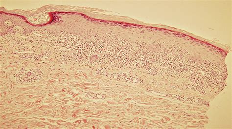 Histological Features Mild Acanthosis Hypergranulosis And Dense