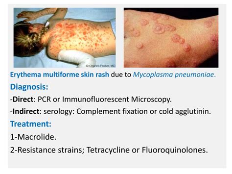 Mycoplasma Pneumonia Rash