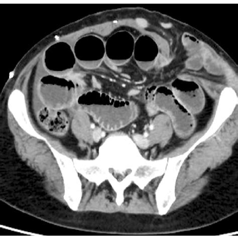 Abdominal Contrast Enhanced Computed Tomography Showing Bowel