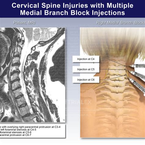 Cervical Spine Injuries With Multiple Medial Branch Block Injection