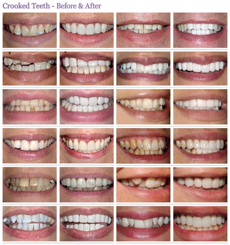 Crooked Or Crowding Teeth Treatment Before And After Photos The Perfect