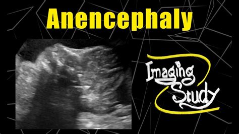 Fetal Anencephaly Neural Tube Defect Ultrasound Case 109 Youtube