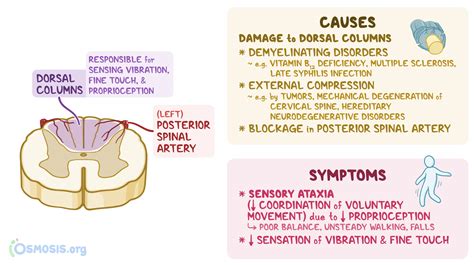 Posterior Cord Syndrome What Is It Causes Signs And Symptoms