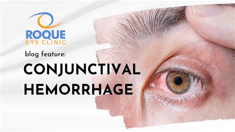 Conjunctival Hemorrhage Roque Eye Clinic Ph