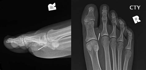Foreign Body Of The Right Foot Lateral And Anteroposterior Radiographs