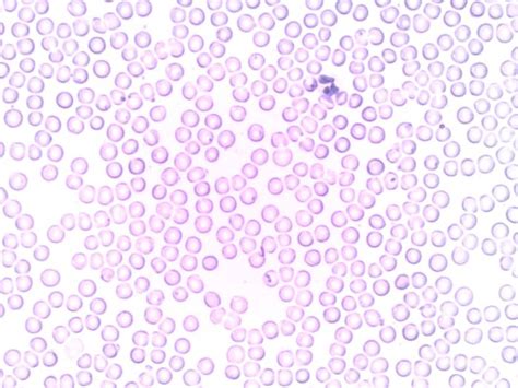 White Blood Cell Leukocyte Test Dlc Tlc Hubpages
