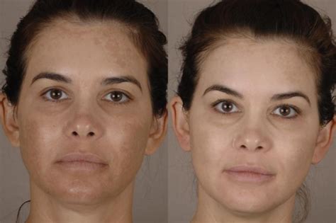 Potenza RF Microneedling Before And After Pictures Case Chico Yuba City Oroville CA