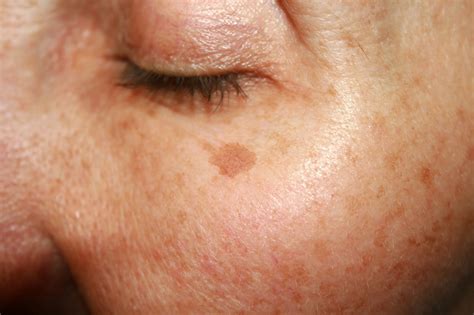 How To Get Rid Of Age Spots Berman Cosmetic Surgery Blog
