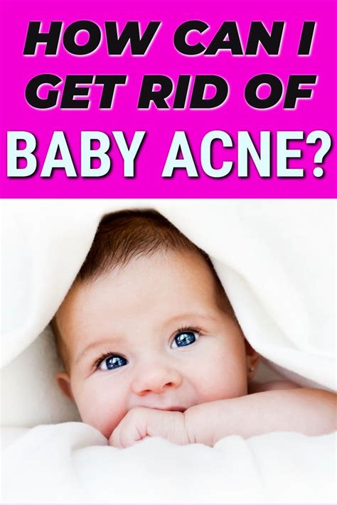 What Causes Baby Acne Simple Ways To Help It Clear Up In 2020 With