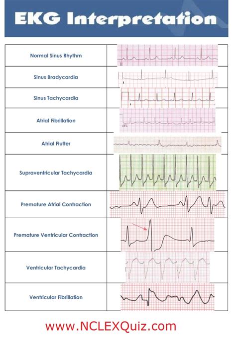 Acls Heart Rhythms Cheat Sheet Pictures To Pin On Pinterest PinsDaddy