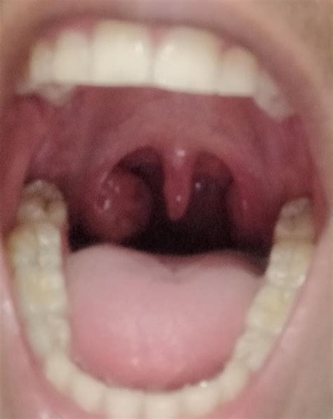 Asymmetrical Tonsils