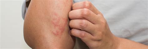 Eczema Causes Mckinney Atopic Dermatitis Dermatologist