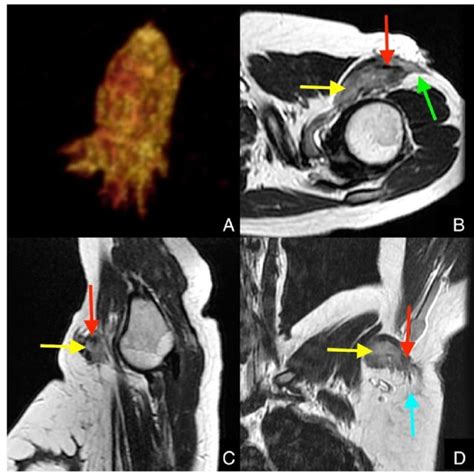 Mri Images Of The Left Armpit A Three Dimensional Reconstruction With