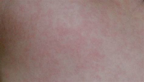 Roseola Symptoms Causes And Treatment